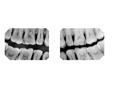 Intraoral Digital X-Ray Sensor | SensorX 