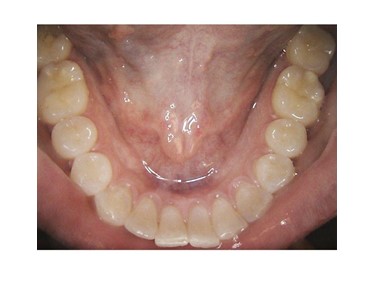 Carestream Dental - Intraoral Camera | CS 1500