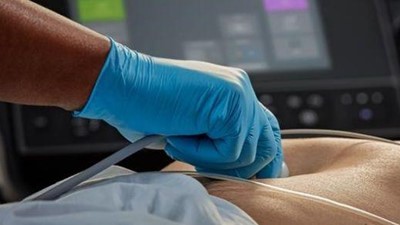 An Introduction to VExUS - Venous Excess Ultrasound Exam