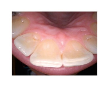 Carestream Dental - Intraoral Camera | CS 1200 