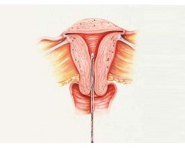 Endometrial Sampling | Pipelle 