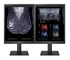 LG - 5MP 21″ Color Mammography 3D-Tomosynthesis Two-Monitor Display Setup