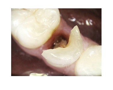 Carestream Dental - Intraoral Camera | CS 1500