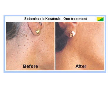 Laser Skin Treatment |  Bulky Skin Lesion Removal