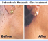 Laser Skin Treatment |  Bulky Skin Lesion Removal