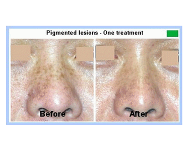 Laser Pigment Removal -  Norseld Lasers