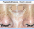 Laser Pigment Removal -  Norseld Lasers