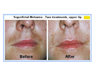 Melasma Treatment - Norseld Lasers