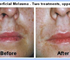 Melasma Treatment - Norseld Lasers