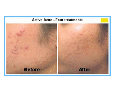 Norseld Acne Treatment