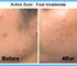 Norseld Acne Treatment