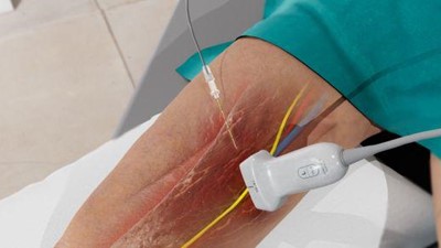 How to Perform an Adductor Canal Block