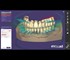 ExoCad - Dental Imaging Software | Stand Alone - Full Denture incl. Ivotion Add-On