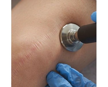 INDIBA - Elite NS - RF Device for Diverse Medical Aesthetic Applications