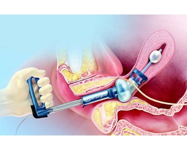 Uterine Manipulator System | RUMI II 