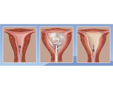 Surgical Ablation Device | Cavaterm Endometrial