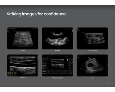 Crystal-Clear Image Samsung V8 Ultrasound