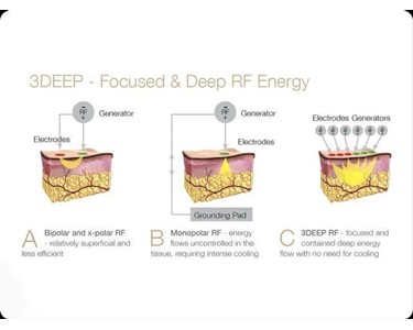 EndyMed - 3DEEP RF Microneedling | EndyMed