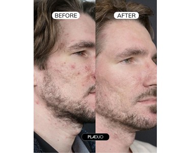 Dual-Plasma Derma Regeneration System