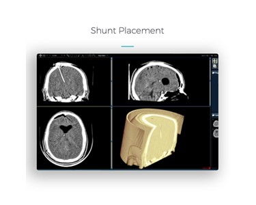 Xoran - CT Scanner | xCAT IQ