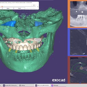 Dental Imaging Software | Exoplan (Surgical Guide)