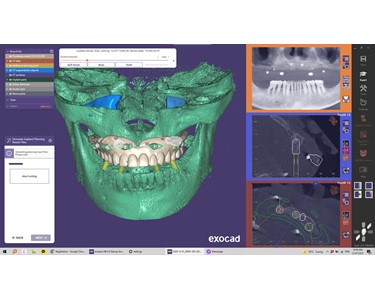 ExoCad - Dental Imaging Software | Exoplan (Surgical Guide)