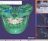 ExoCad - Dental Imaging Software | Exoplan (Surgical Guide)