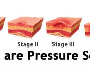 What is the term for ulcers & sores caused by pressure & shear forces?