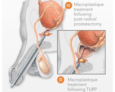 Macroplastique Mild SUI (Stress Urinary Incontinence)