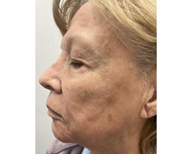 Lumenis - Lumenis Acupulse 