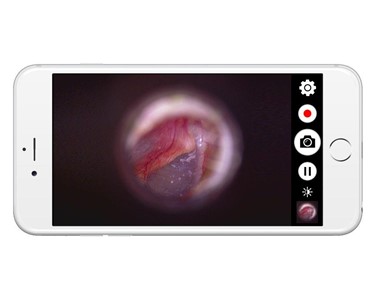 Firefly - Wireless HD Digital Video Otoscope for ENT and Audiology