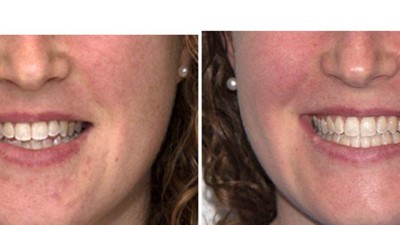 Class I – Crowding, Shallow Overbite (SureSmile Aligners)