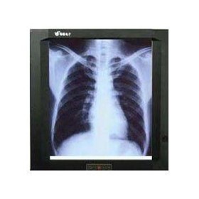 X-Ray Viewing Box | VBATX-100