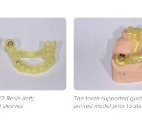 Using a 3D Printed Surgical Guide for Implant Placement in a Partial Edentulism Case
