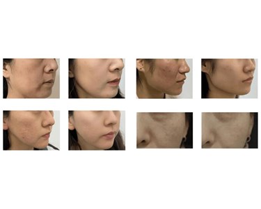 Thulium Laser