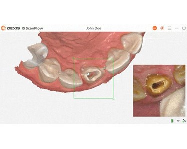 Dexis - Imprevo Intraoral Scanner
