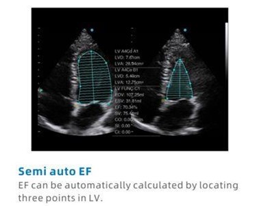 SIUI - Apogee 2100 Plus Digital Color Doppler Ultrasound Imaging System