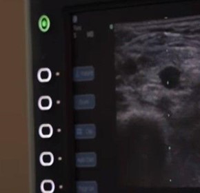 White Memorial Scores Zero CLABSI and iatrogenic pneumothoraces