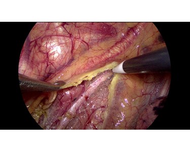 Mindray - HyPixel™ U1 Endoscope Camera System