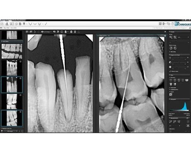 Intraoral Digital X-Ray Sensor | SensorX 