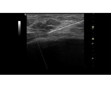 B-Steer + Needle Recognition Breast Mass Injection